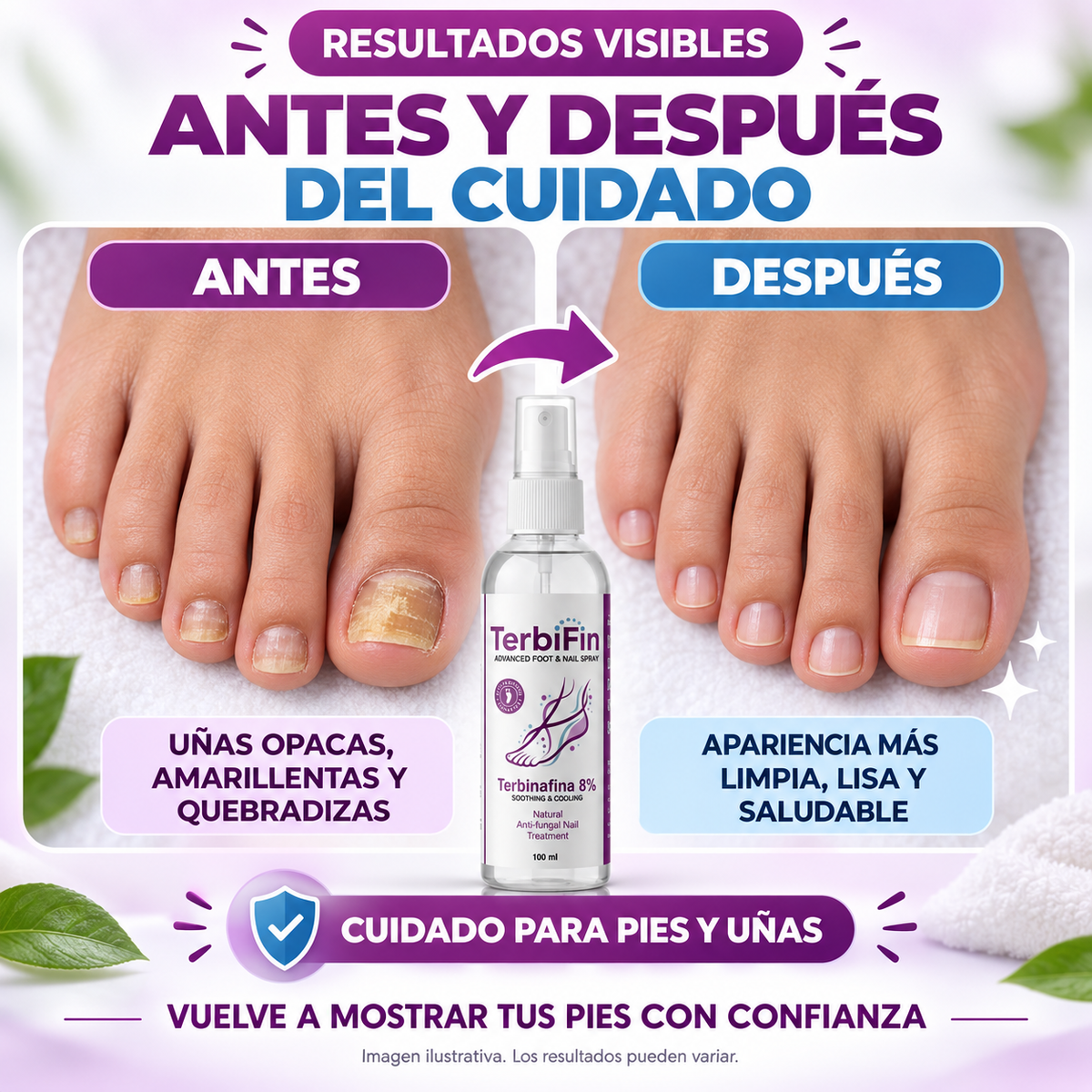 TerbiFin Spray, antes y después del cuidado de uñas (imagen ilustrativa)