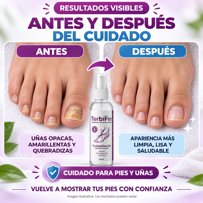 TerbiFin Spray, antes y después del cuidado de uñas (imagen ilustrativa)